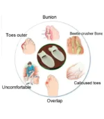 Bunion Silicone Splint Big Toe Separator